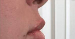 Face before dermal filler treatment, side profile view — Dr. Rudderman, Atlanta.