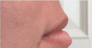 Face after dermal filler treatment, side profile view — Dr. Rudderman, Atlanta.