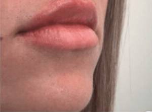 Face after dermal filler treatment, three-quarter view — Dr. Rudderman, Atlanta.