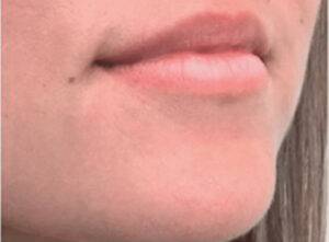 Face before dermal filler treatment, three-quarter view — Dr. Rudderman, Atlanta.