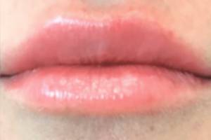 Face after dermal filler treatment, front view — Dr. Rudderman, Atlanta.