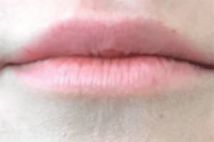 Face before dermal filler treatment, front view — Dr. Rudderman, Atlanta.