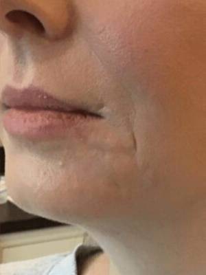 Face after dermal filler treatment, three-quarter view — Dr. Rudderman, Atlanta.