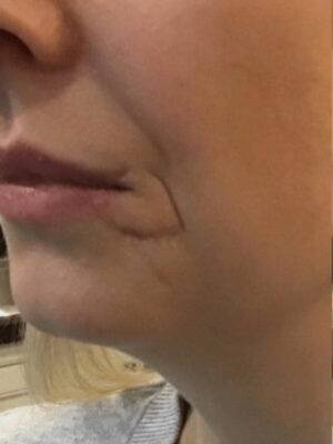 Face before dermal filler treatment, three-quarter view — Dr. Rudderman, Atlanta.
