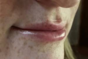 Face after dermal filler treatment, three-quarter view — Dr. Rudderman, Atlanta.