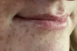 Face before dermal filler treatment, three-quarter view — Dr. Rudderman, Atlanta.