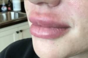 Face after dermal filler treatment, three-quarter view — Dr. Rudderman, Atlanta.