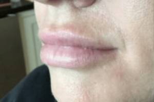 Face before dermal filler treatment, three-quarter view — Dr. Rudderman, Atlanta.