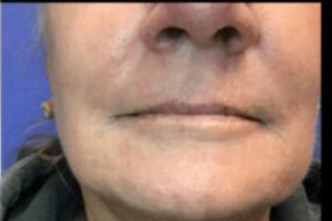 Dermal filler treatment patient photo, front view of the face — Dr. Rudderman, Atlanta.