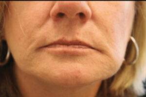Dermal filler treatment patient photo, front view of the face — Dr. Rudderman, Atlanta.