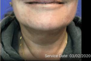 Dermal filler treatment patient photo, front view of the face — Dr. Rudderman, Atlanta.