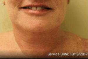 Dermal filler treatment patient photo, front view of the face — Dr. Rudderman, Atlanta.