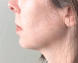 Dermal filler treatment patient photo, side profile view of the face — Dr. Rudderman, Atlanta.