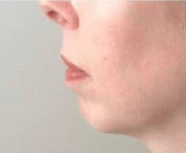 Dermal filler treatment patient photo, side profile view of the face — Dr. Rudderman, Atlanta.