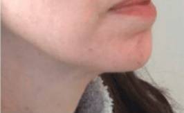 Dermal filler treatment patient photo, side profile view of the face — Dr. Rudderman, Atlanta.