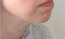 Dermal filler treatment patient photo, side profile view of the face — Dr. Rudderman, Atlanta.