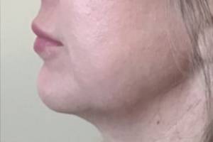 Dermal filler treatment patient photo, side profile view of the face — Dr. Rudderman, Atlanta.