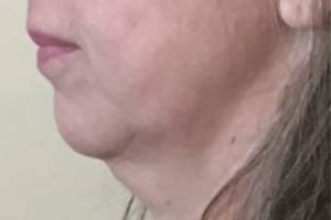 Dermal filler treatment patient photo, side profile view of the face — Dr. Rudderman, Atlanta.