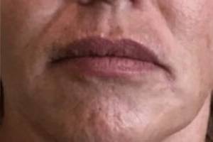 Dermal filler treatment patient photo, front view of the face — Dr. Rudderman, Atlanta.