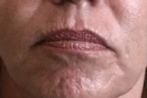 Dermal filler treatment patient photo, front view of the face — Dr. Rudderman, Atlanta.
