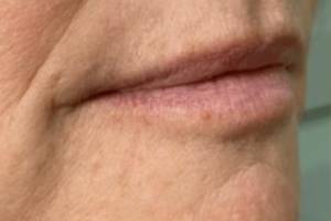 Face before dermal filler treatment, three-quarter view — Dr. Rudderman, Atlanta.