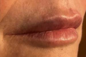 Face after dermal filler treatment, three-quarter view — Dr. Rudderman, Atlanta.