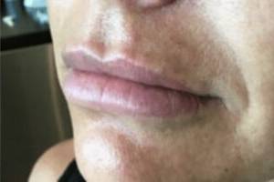 Face after dermal filler treatment, three-quarter view — Dr. Rudderman, Atlanta.