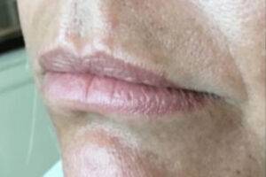 Face before dermal filler treatment, three-quarter view — Dr. Rudderman, Atlanta.