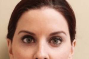 Dermal filler treatment patient photo, front view of the face — Dr. Rudderman, Atlanta.