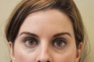 Dermal filler treatment patient photo, front view of the face — Dr. Rudderman, Atlanta.