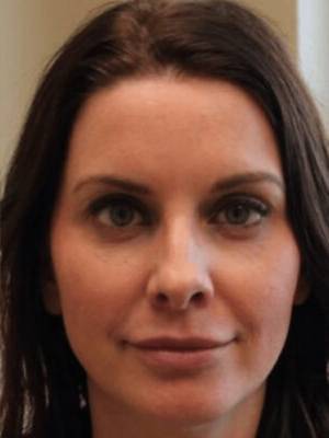 Dermal filler treatment patient photo, front view of the face — Dr. Rudderman, Atlanta.