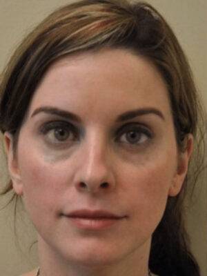 Dermal filler treatment patient photo, front view of the face — Dr. Rudderman, Atlanta.