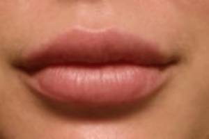 Face after dermal filler treatment, front view — Dr. Rudderman, Atlanta.