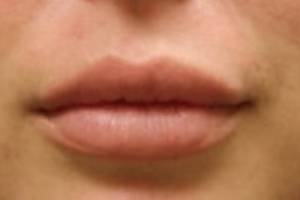 Face before dermal filler treatment, front view — Dr. Rudderman, Atlanta.