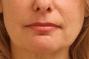 Dermal filler treatment patient photo, front view of the face — Dr. Rudderman, Atlanta.