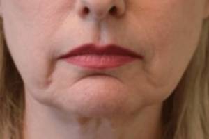 Dermal filler treatment patient photo, front view of the face — Dr. Rudderman, Atlanta.