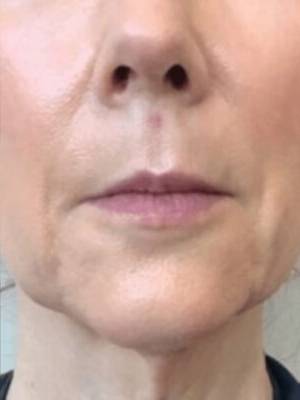 Dermal filler treatment patient photo, front view of the face — Dr. Rudderman, Atlanta.