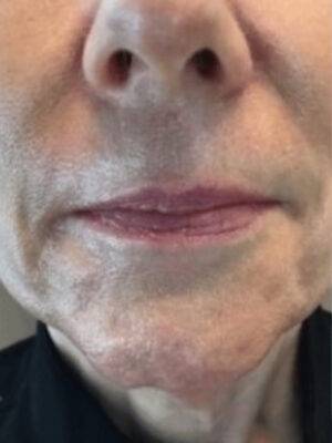 Dermal filler treatment patient photo, front view of the face — Dr. Rudderman, Atlanta.