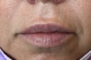 Dermal filler treatment patient photo, front view of the face — Dr. Rudderman, Atlanta.