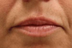 Dermal filler treatment patient photo, front view of the face — Dr. Rudderman, Atlanta.