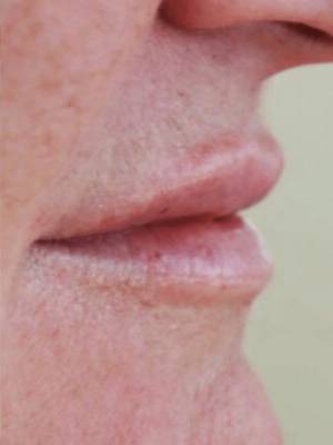 Face after dermal filler treatment, side profile view — Dr. Rudderman, Atlanta.