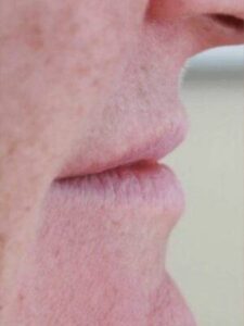 Face before dermal filler treatment, side profile view — Dr. Rudderman, Atlanta.