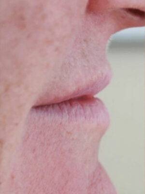 Face before dermal filler treatment, side profile view — Dr. Rudderman, Atlanta.