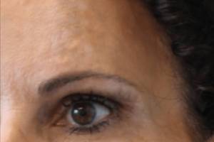 Dermal filler treatment patient photo, three-quarter view of the face — Dr. Rudderman, Atlanta.