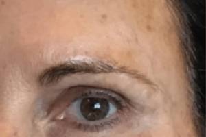 Dermal filler treatment patient photo, three-quarter view of the face — Dr. Rudderman, Atlanta.