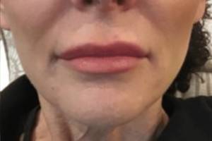 Dermal filler treatment patient photo, front view of the face — Dr. Rudderman, Atlanta.