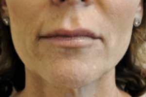 Dermal filler treatment patient photo, front view of the face — Dr. Rudderman, Atlanta.