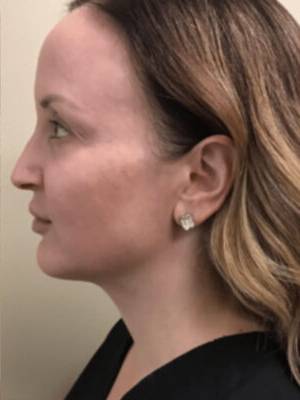 Dermal filler treatment patient photo, side profile view of the face — Dr. Rudderman, Atlanta.