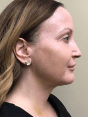 Dermal filler treatment patient photo, side profile view of the face — Dr. Rudderman, Atlanta.
