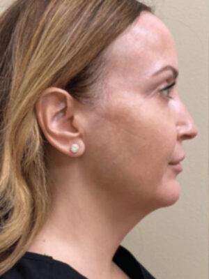 Dermal filler treatment patient photo, side profile view of the face — Dr. Rudderman, Atlanta.